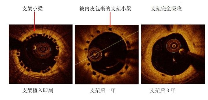 生物材料創(chuàng)新引領醫(yī)療植入物革新，未來醫(yī)療領域的希望之星